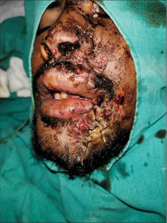A 26-year-old male with history of trauma. Pre-operative picture with stay sutures.