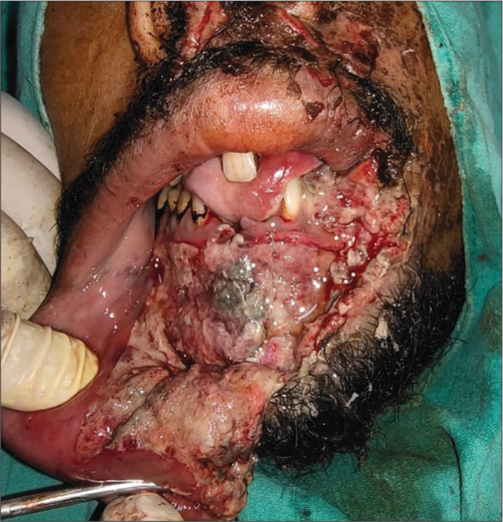 Image showing degloving injury with necrosed tissues.