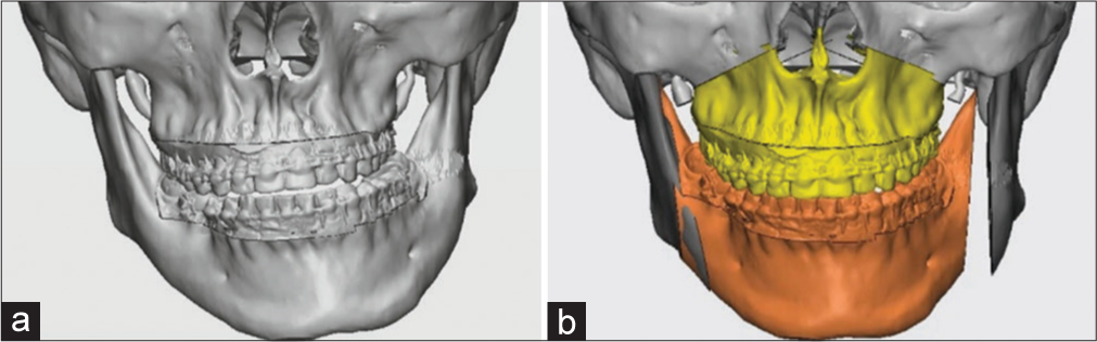 (a and b) Artificial intelligence and orthognathic surgeries