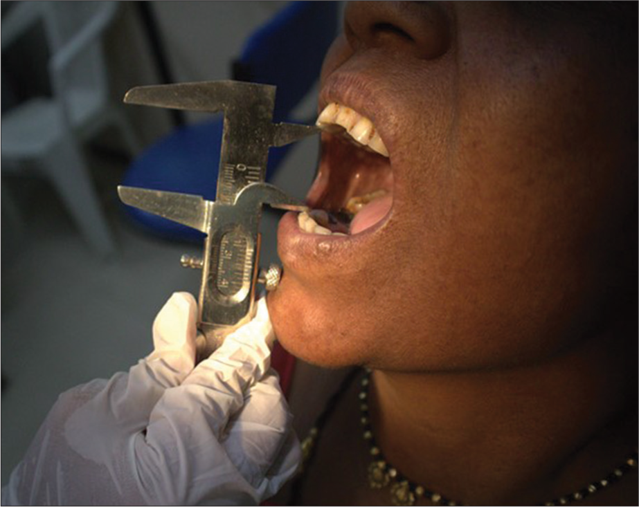 Interincisal mouth opening measurement in oral submucous fibrosis patient using Vernier caliper.