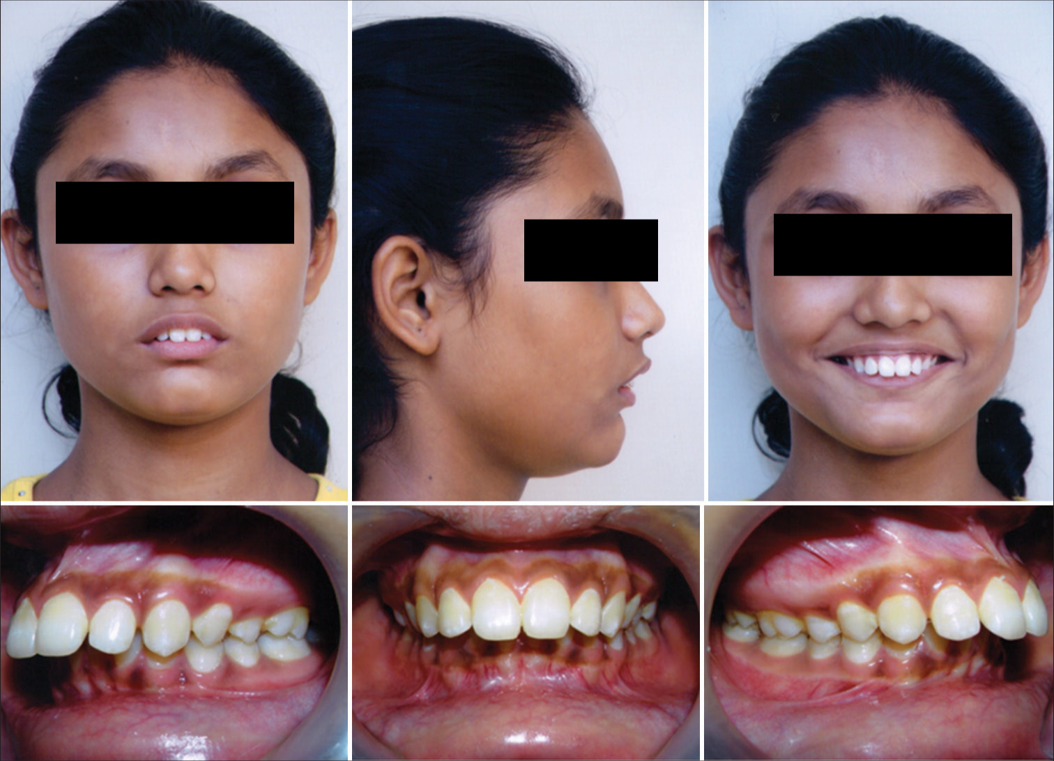 Pre-treatment extra-oral and intra-oral photographs.