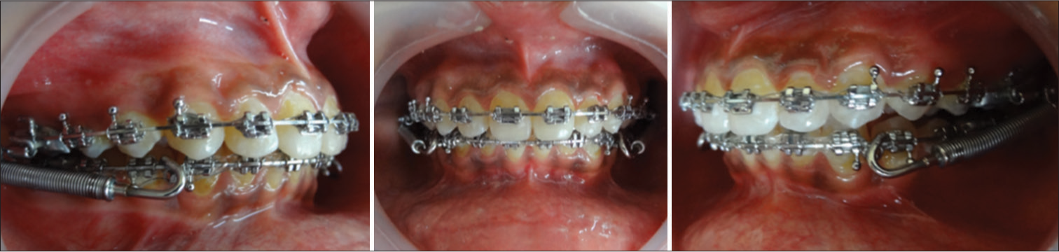 Mid-treatment intraoral photographs with Forsus fatigue-resistant device.