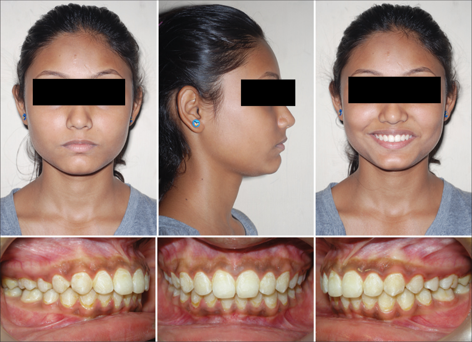 Post-treatment extra-oral and intra-oral photographs.