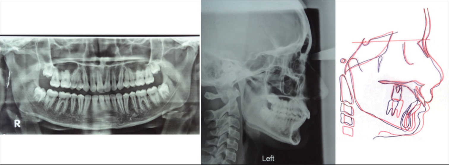 Post-treatment orthopantomogram, lateral cephalogram, and superimposition, pre-treatment (black lines), post-treatment (red lines)