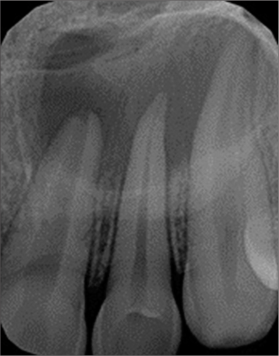 Pre-operative periapical radiograph.