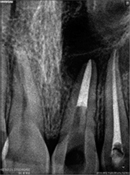 Root end barrier with mineral trioxide aggregate (MTA).