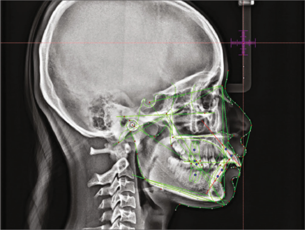 Artificial intelligence in landmark identification. Green lines indicate tracing of skeletal, dental and soft tissue structures.