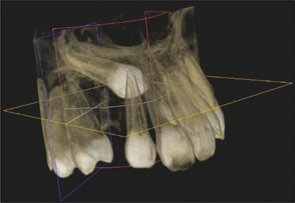 Artificial intelligence and impacted canine.