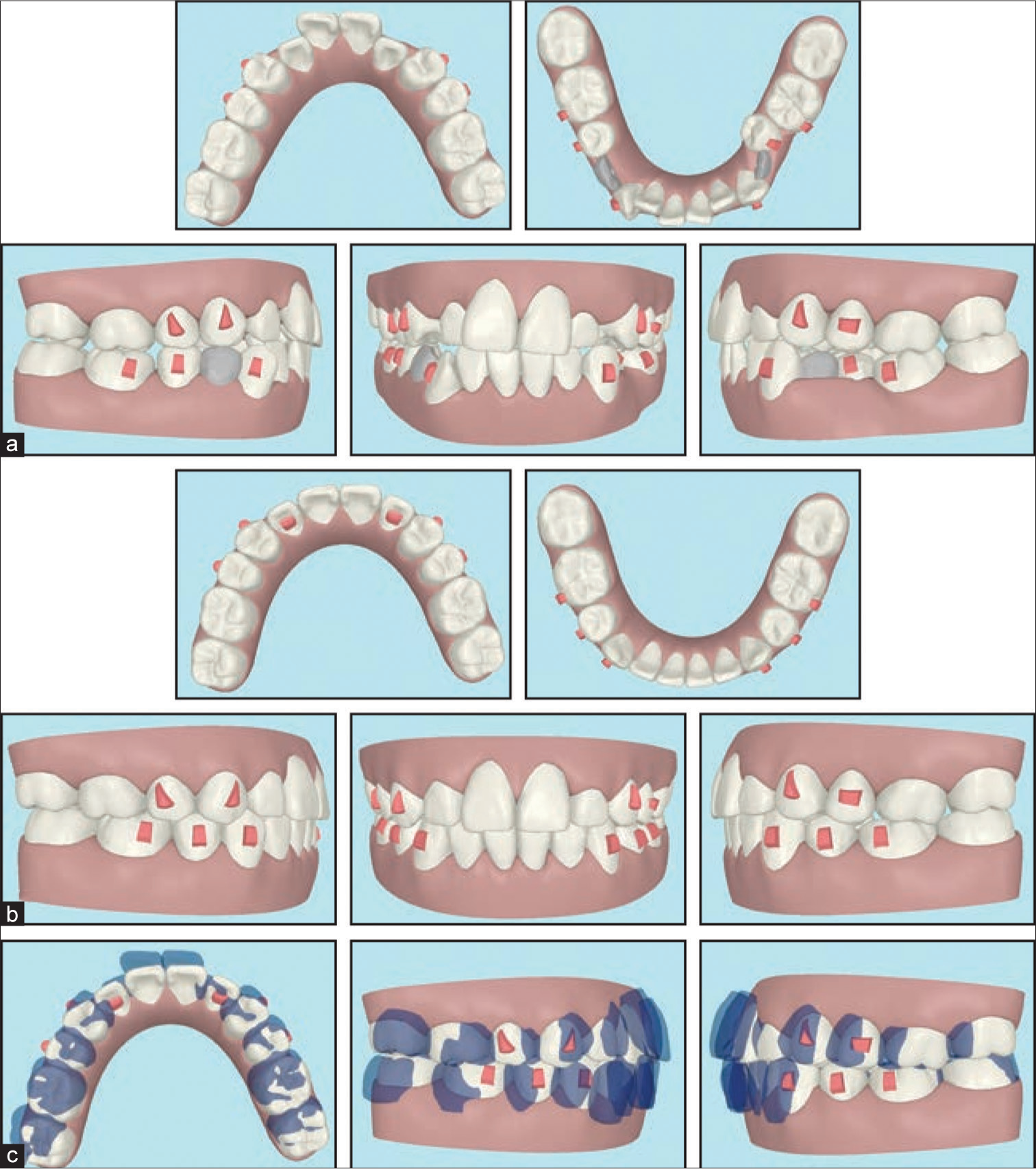 Artificial intelligence in prediction of extraction. (a) Pretreatment photographs and AI predicting the first premolar extraction in lower arch, (b) Post treatment photographs predicting the teeth position after the treatment is completed, (c) Superimposition of pretreatment and post treatment photographs.