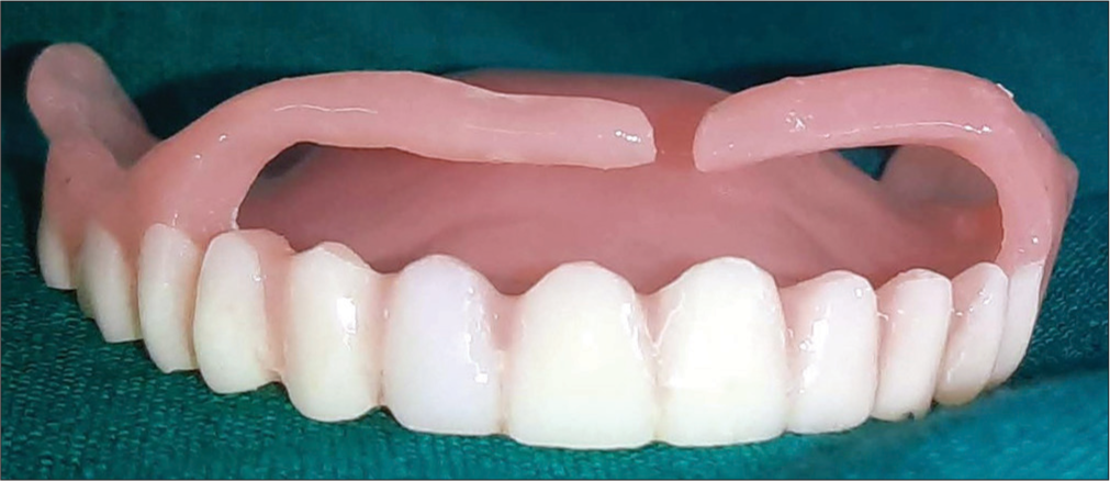 Wing denture.