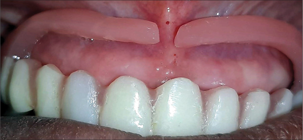 Wing denture (in patient’s mouth).