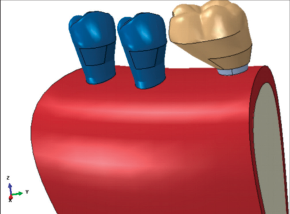 First model created by connecting three tooth veneers.