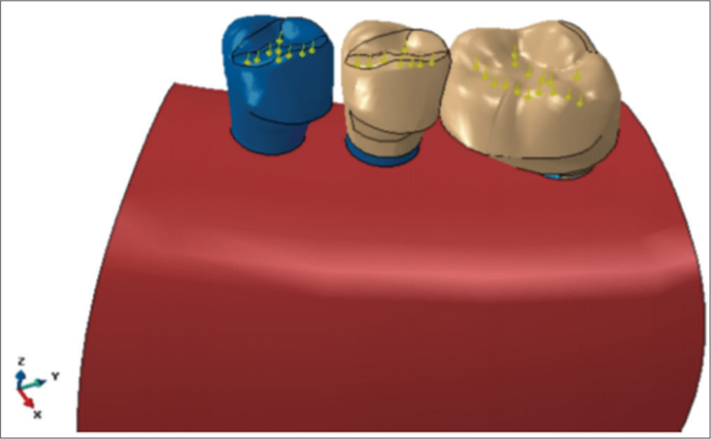 Second model created by disconnecting the fourth tooth.