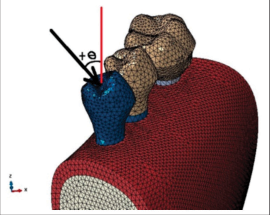 AApplying the force with the specific angulation. (+e: the angle between the applied force and tooth long axis)