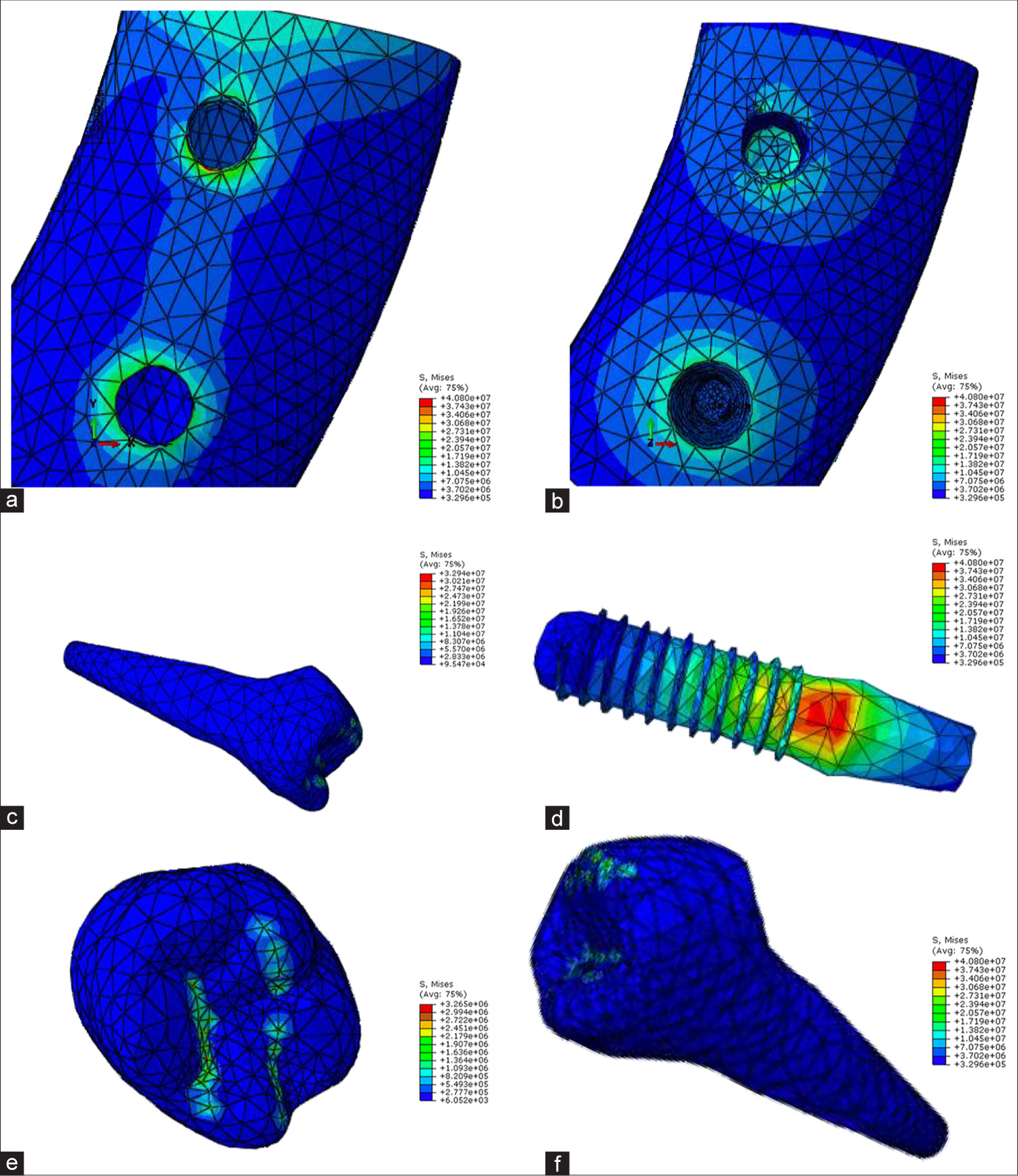 Model A force angle 0 (a: cortical bone, b: cancellous bone, c: tooth 5, d: implant, e: crown, f: tooth 4)