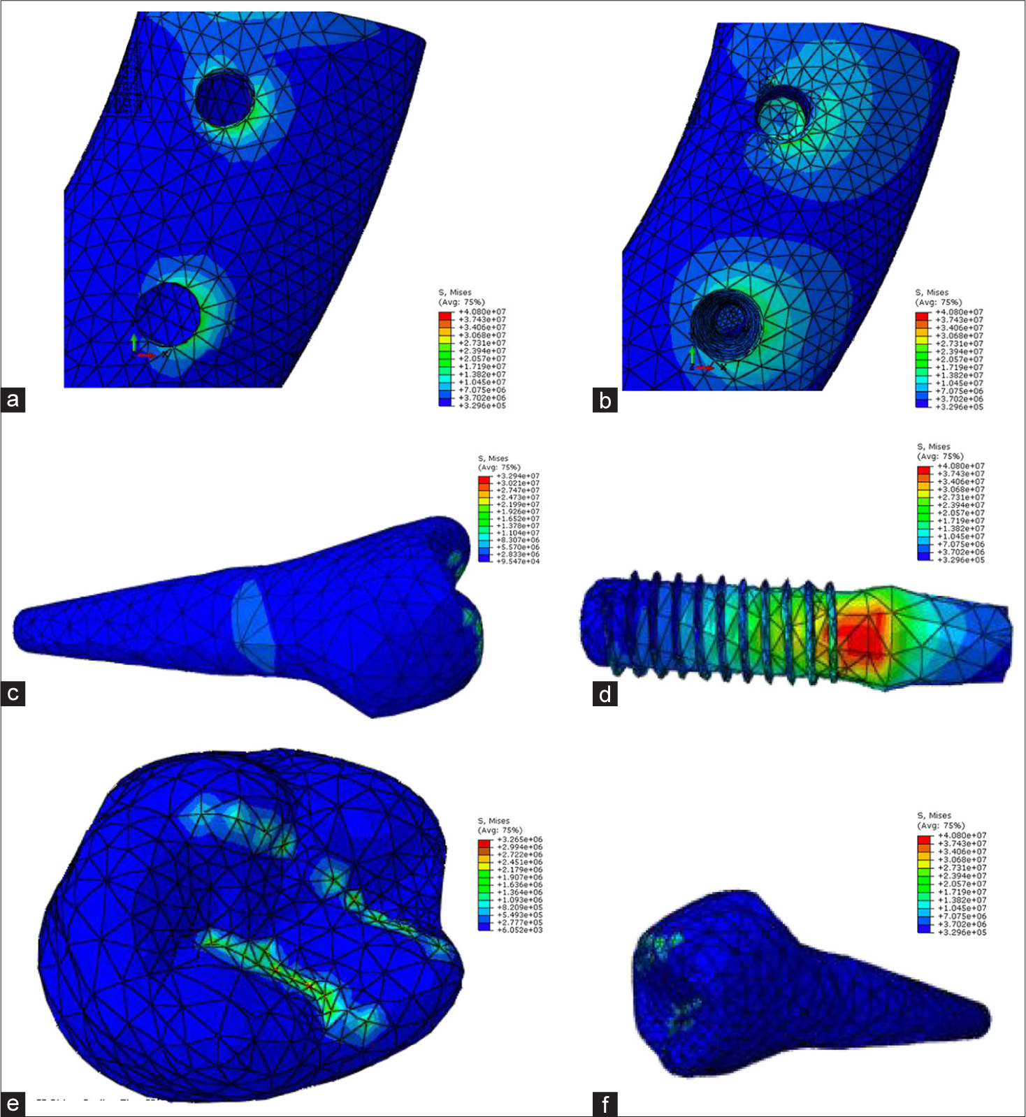 Model A force angle 15 (a: cortical bone, b: cancellous bone, c: tooth 5, d: implant, e: crown, f: tooth 4).