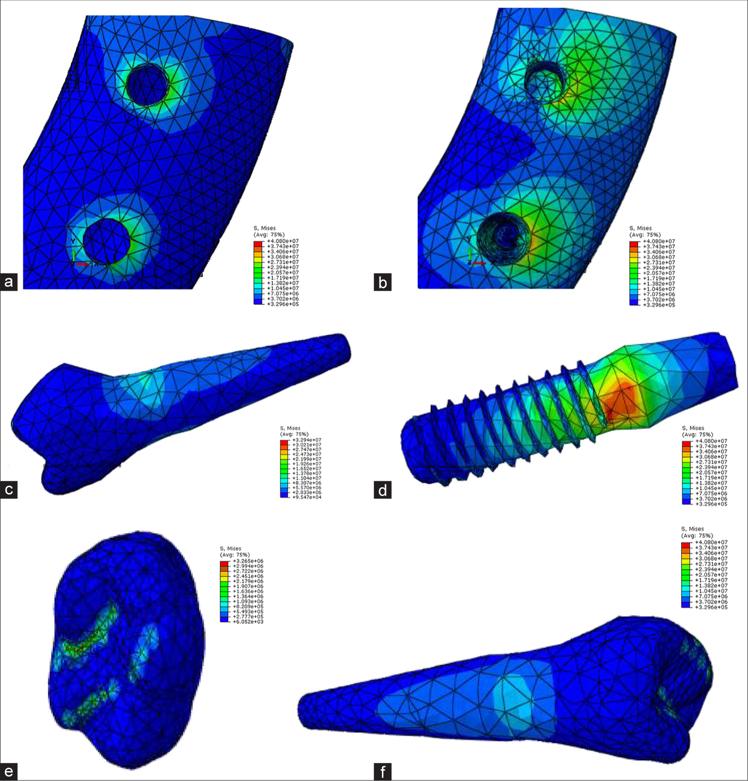 Model A force angle 45 (a: cortical bone, b: cancellous bone, c: tooth 5, d: implant, e: crown, f: tooth 4).