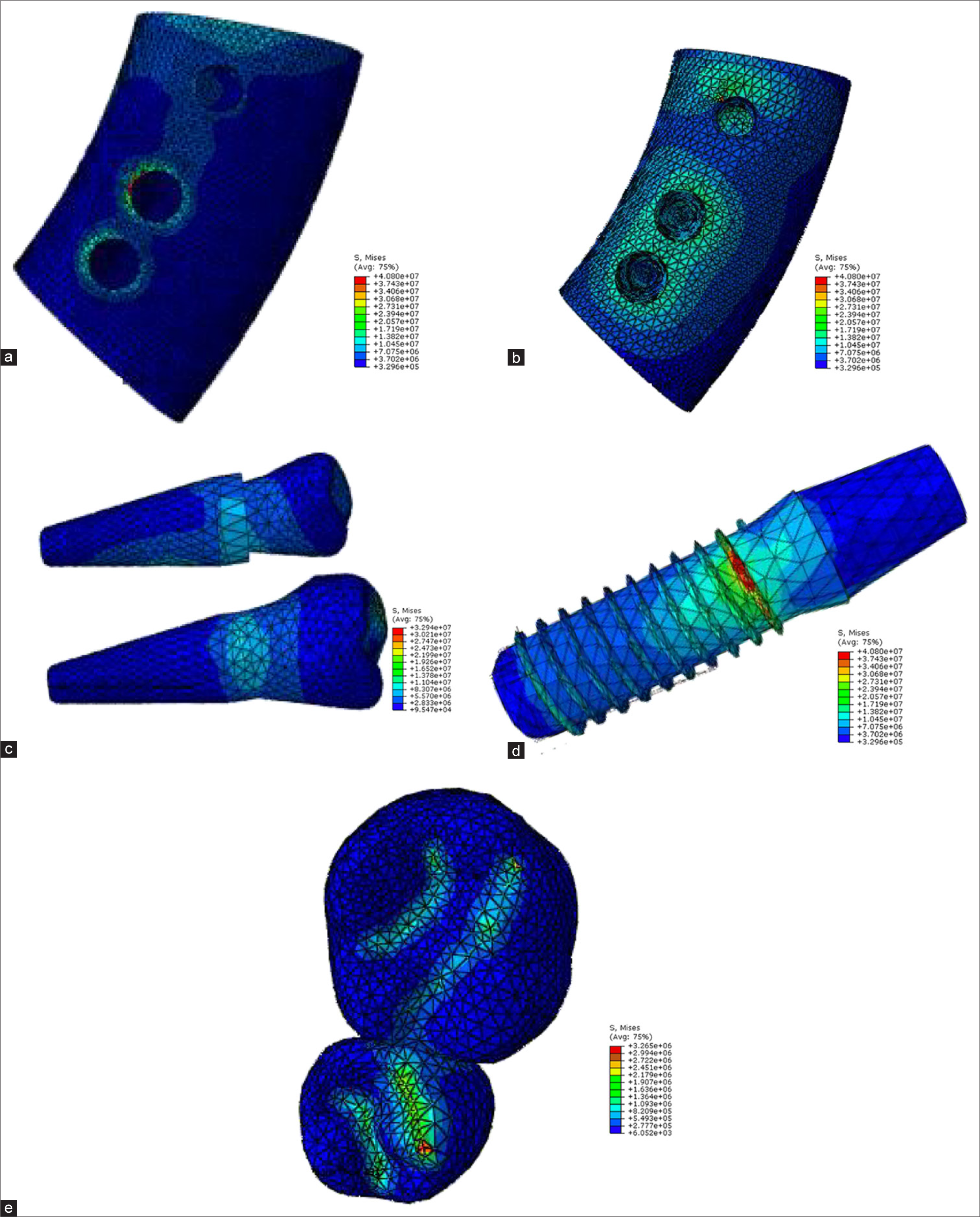 Model B force angle 0 (a: cortical bone, b: cancellous bone, c: teeth 4 and 5, d: implant, e: crown).