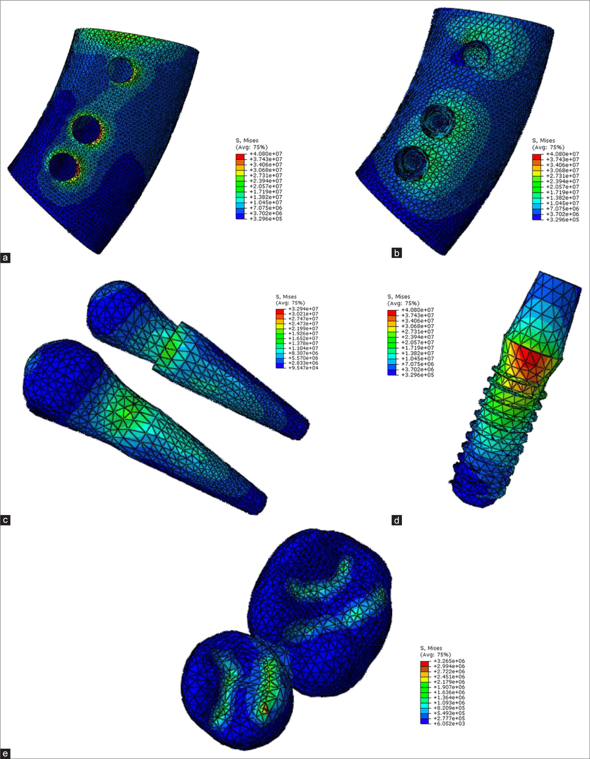 Model B force angle 15 (a: cortical bone, b: cancellous bone, c: teeth 4 and 5, d: implant, e: crown).