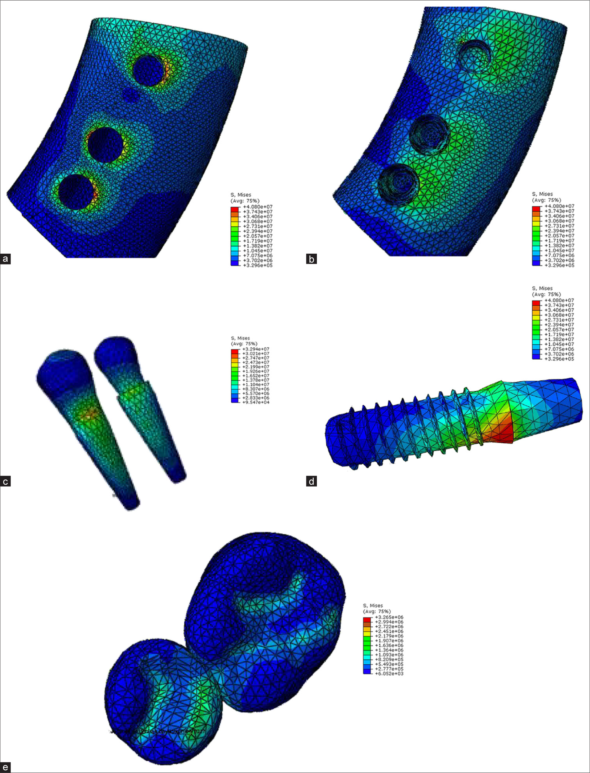 Model B force angle 45 (a: cortical bone, b: cancellous bone, c: teeth 4 and 5, d: implant, e: crown).